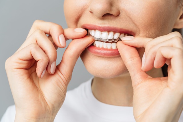 Invisalign Treatment