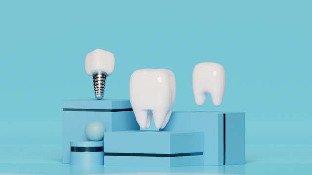 How Long Do Dental Crowns Last? - img 2 - Blog VIP Dental Care