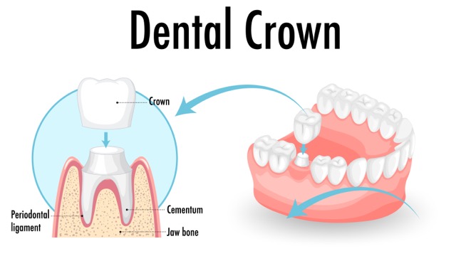 How Long Do Dental Crowns Last? - img 1 - Blog VIP Dental Care