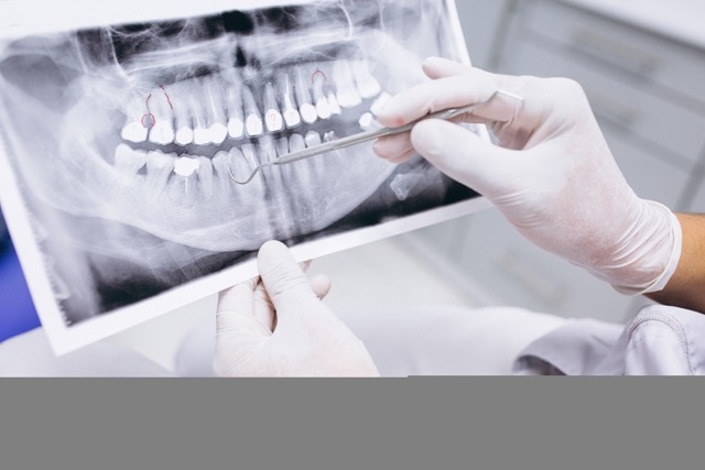 Mini Dental Implants vs Traditional Implants: Which One Is Better? - img 2 - Blog VIP Dental Care