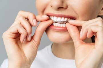 Top Braces Only or Bottom Braces Only: Is Single-Arch Treatment Right for You?