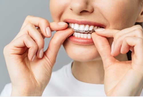 Top Braces Only or Bottom Braces Only: Is Single-Arch Treatment Right for You? - VIP Dental Care, Forest Hills NY
