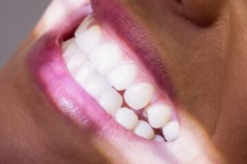 Professional teeth whitening treatment cost and options